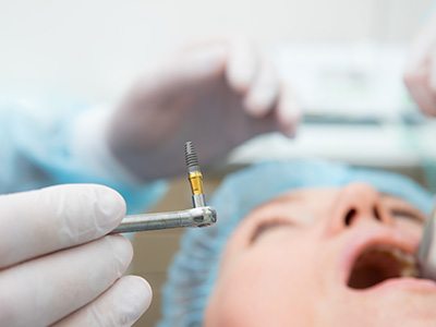 dentist holding dental implant