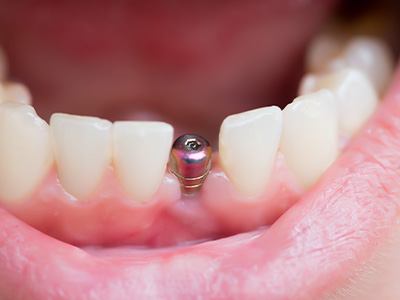 closeup of dental implant in patient's mouth