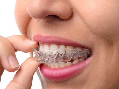 Closeup of woman removing Invisalign from upper arch