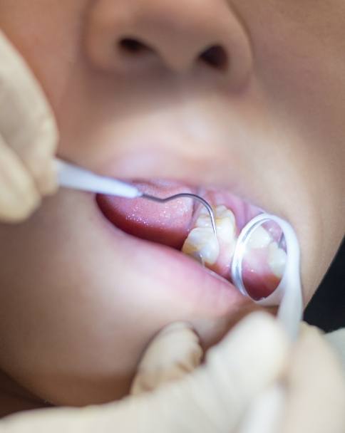 Close up of childrens dentist giving a child a dental exam