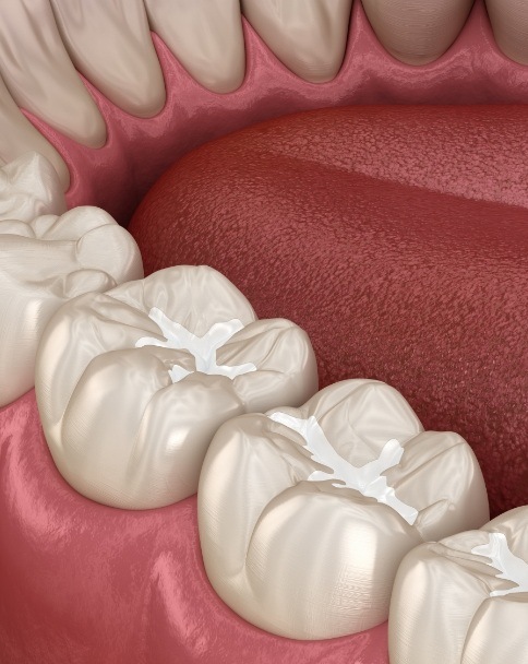 Animated row of teeth with tooth colored fillings for kids