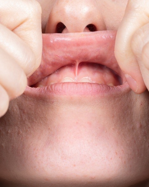 Close up of person stretching their upper lip