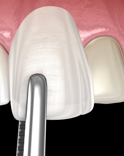 Animated dental veneer being placed over the front of a tooth