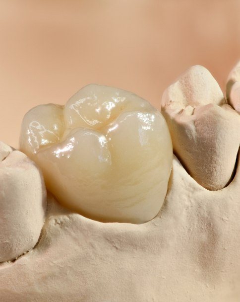 Close up of dental crown in a model of the mouth