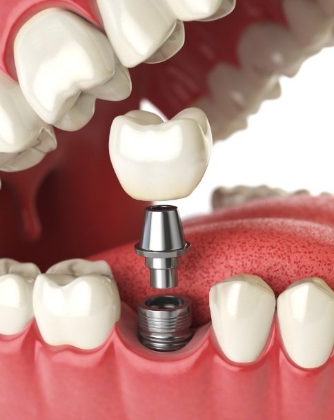 Animated dental implant with crown in the lower jaw