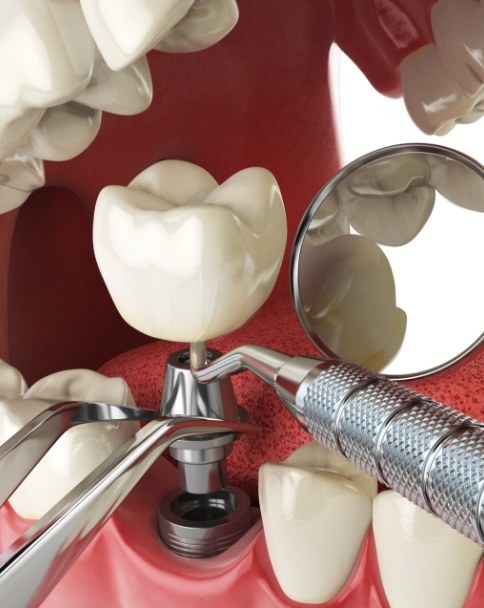 Animated dental implant being placed in the lower jaw