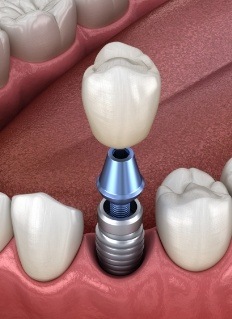 Animated dental crown being placed over a dental implant