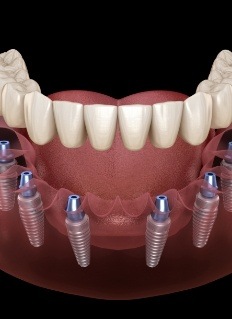 Animated full denture being placed over six dental implants