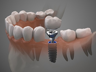 Dental implant, abutment, and crown between natural teeth