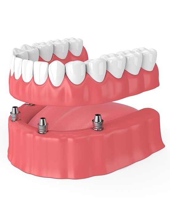 Illustration of implant dentures in Mesquite, TX