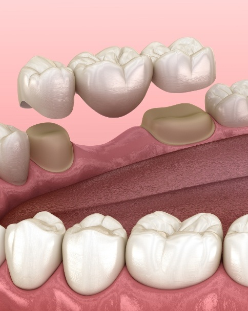 Animated dental bridge being fitted to replace missing tooth
