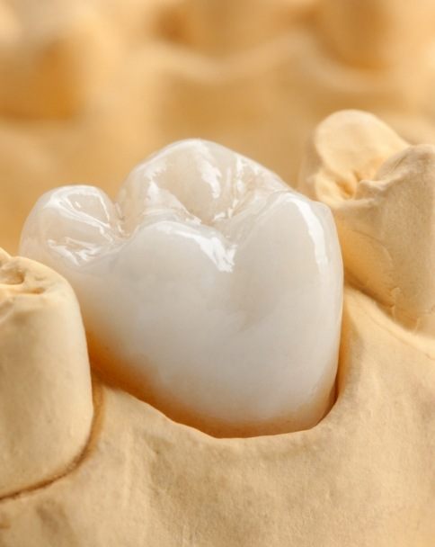 Close up of dental crown in model of the mouth