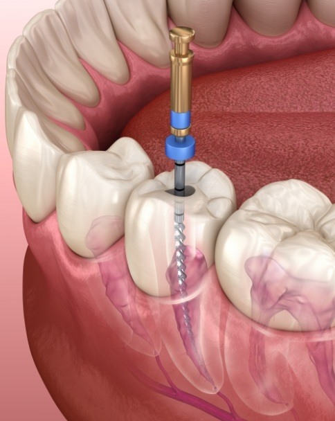 Animated dental instrument cleaning the inside of a tooth during root canal treatment