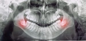 X-ray of wisdom teeth in lower arch highlight red