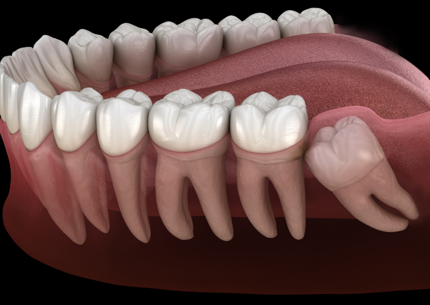 3D image of wisdom teeth